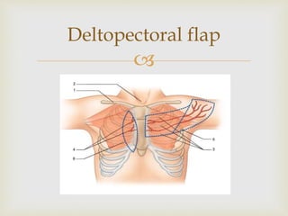 Deltopectoral flap 
 
 