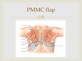 PMMC flap 
 
 