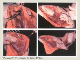  
Preserve 2nd 3rd perforator for future DP flap 
 