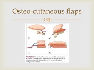 Osteo-cutaneous flaps 
 
 