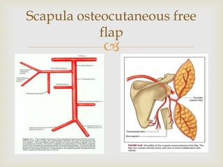 Scapula osteocutaneous free 
flap 
 
 