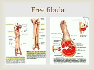 Free fibula 
 