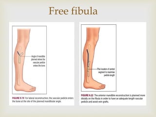 Free fibula 
 