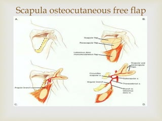Scapula osteocutaneous free flap 
 