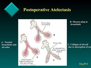 Postoperative Atelectasis Fig. 19-4 Normal  bronchiole and alveolus B. Mucous plug in bronchiole C. Collapse of alveoli due to absorption of air 