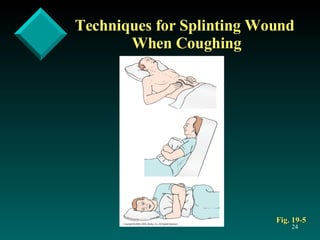 Techniques for Splinting Wound  When Coughing Fig. 19-5 