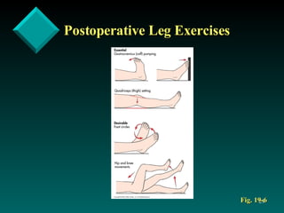 Postoperative Leg Exercises Fig. 19-6 