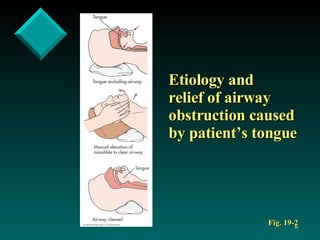Etiology and  relief of airway obstruction caused by patient’s tongue Fig. 19-2 