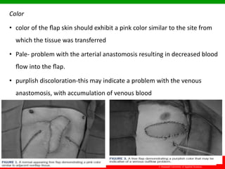 © Ramaiah University of Applied Sciences
29
Faculty of Dental Sciences
Color
• color of the ﬂap skin should exhibit a pink color similar to the site from
which the tissue was transferred
• Pale- problem with the arterial anastomosis resulting in decreased blood
ﬂow into the ﬂap.
• purplish discoloration-this may indicate a problem with the venous
anastomosis, with accumulation of venous blood
 