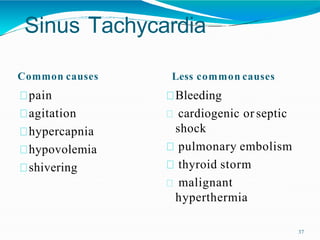Sinus Tachycardia
37
Common causes
pain
agitation
hypercapnia
hypovolemia
shivering
Less common causes
Bleeding
cardiogenic or septic
shock
pulmonary embolism
thyroid storm
malignant
hyperthermia
 