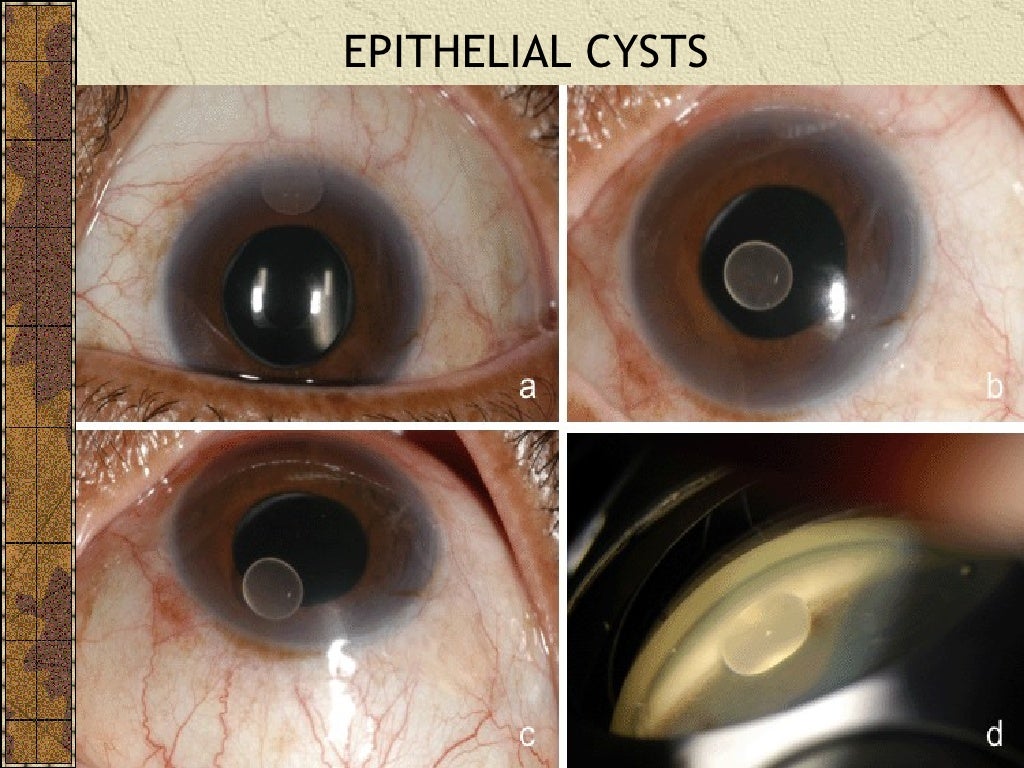CATARACT SURGERY COMPLICATIONS