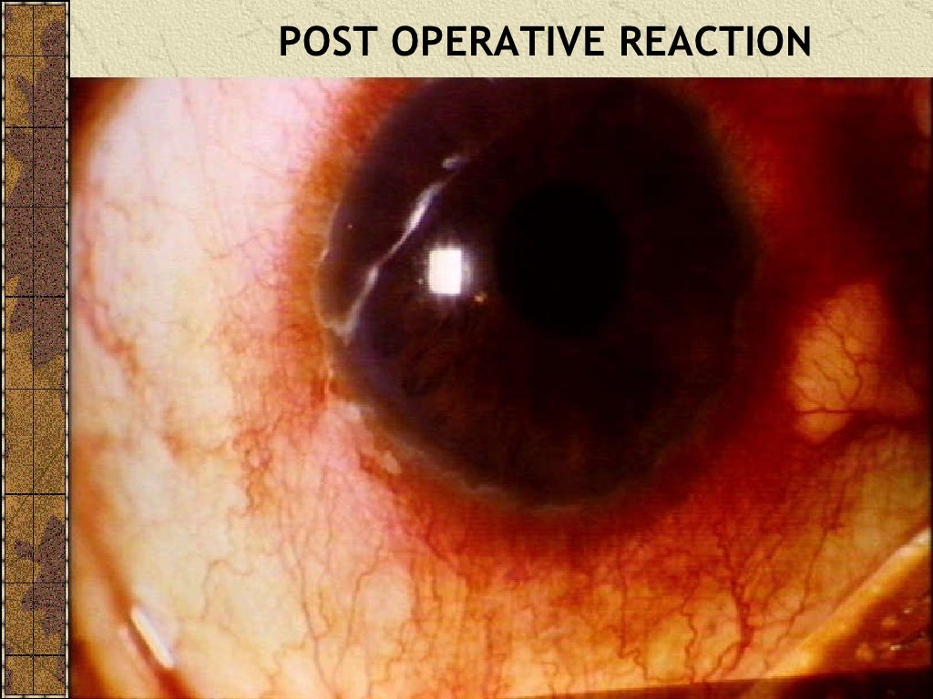 CATARACT SURGERY COMPLICATIONS