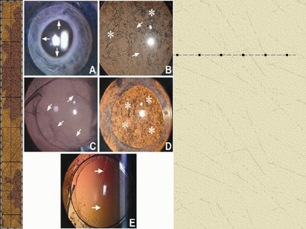 CATARACT SURGERY COMPLICATIONS