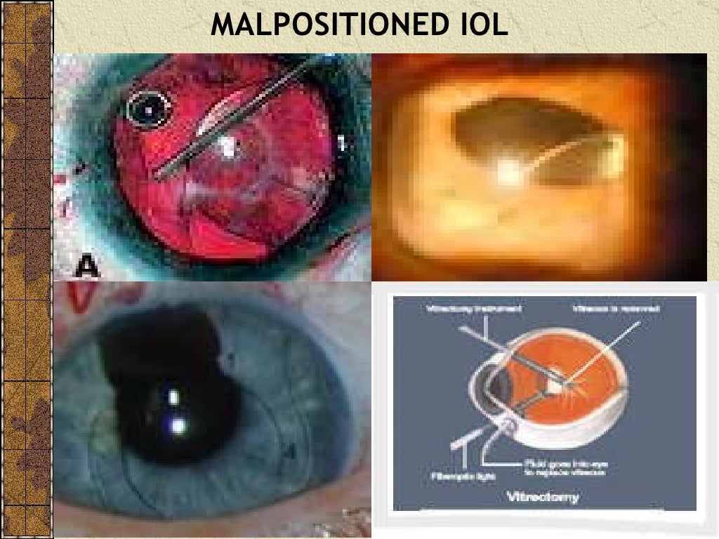 CATARACT SURGERY COMPLICATIONS