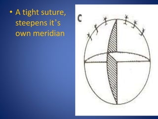 • A tight suture,
steepens it’s
own meridian
 