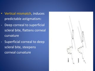 • Vertical mismatch, induces
predictable astigmatism:
- Deep corneal to superficial
scleral bite, flattens corneal
curvature
- Superficial corneal to deep
scleral bite, steepens
corneal curvature
 