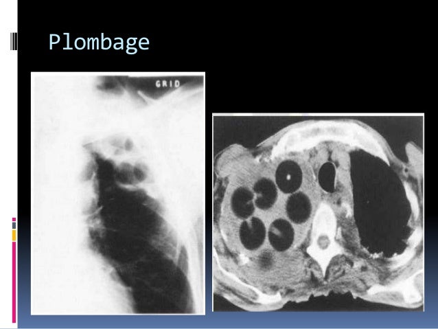 Post Operative Chest