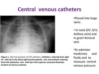 Post operative chest imaging | PPTX