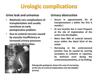 Post operative complications of renal transplant | PPT