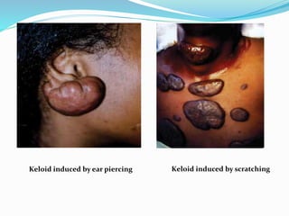 Keloid induced by ear piercing Keloid induced by scratching 
 