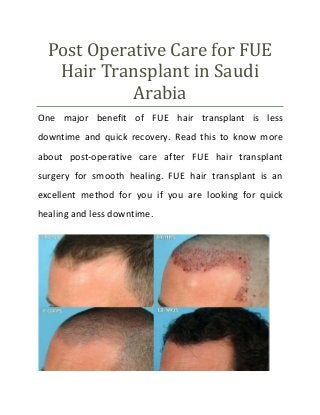 Post Operative Care for FUE
Hair Transplant in Saudi
Arabia
One major benefit of FUE hair transplant is less
downtime and quick recovery. Read this to know more
about post-operative care after FUE hair transplant
surgery for smooth healing. FUE hair transplant is an
excellent method for you if you are looking for quick
healing and less downtime.
 