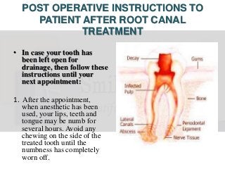 POST OPERATIVE INSTRUCTIONS TO
PATIENT AFTER ROOT CANAL
TREATMENT
• In case your tooth has
been left open for
drainage, then follow these
instructions until your
next appointment:
1. After the appointment,
when anesthetic has been
used, your lips, teeth and
tongue may be numb for
several hours. Avoid any
chewing on the side of the
treated tooth until the
numbness has completely
worn off.
 