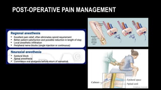 POST-OPERATIVE PAIN MANAGEMENT
 
