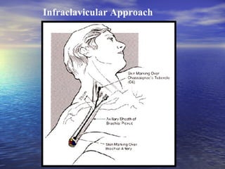 Infraclavicular Approach

 