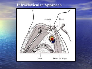 Infraclavicular Approach

 