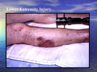 Lower Extremity Injury

 