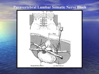 Paravertebral Lumbar Somatic Nerve Block

 