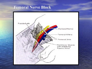 Femoral Nerve Block

 