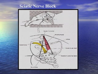 Sciatic Nerve Block

 
