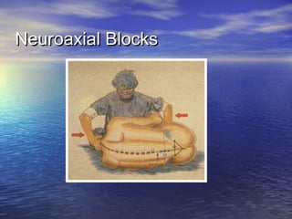 Neuroaxial Blocks

 