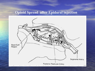 Opioid Spread after Epidural injection

 