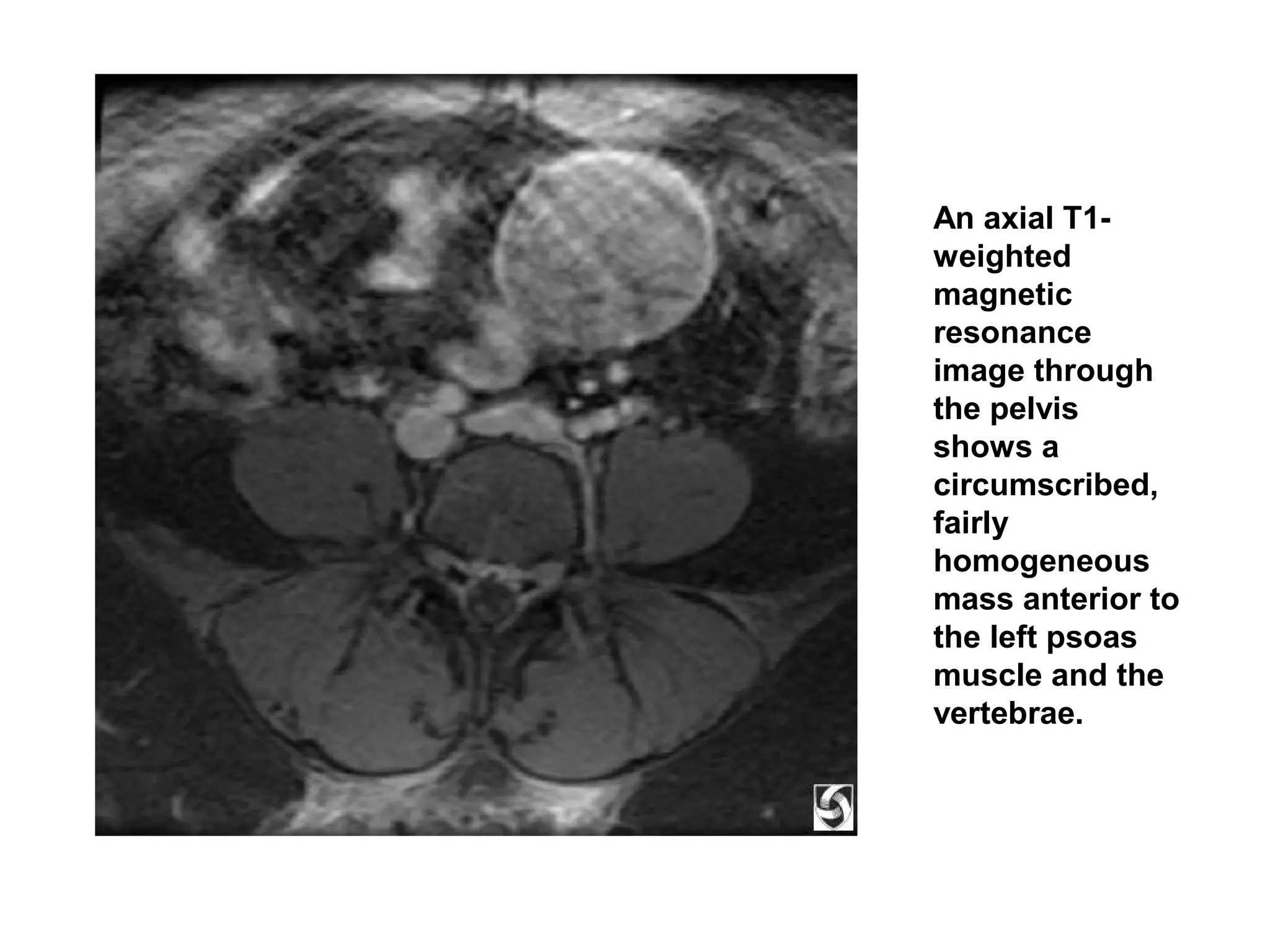 Postoperative retained foreign bodies | PDF | Digestive Disorders ...