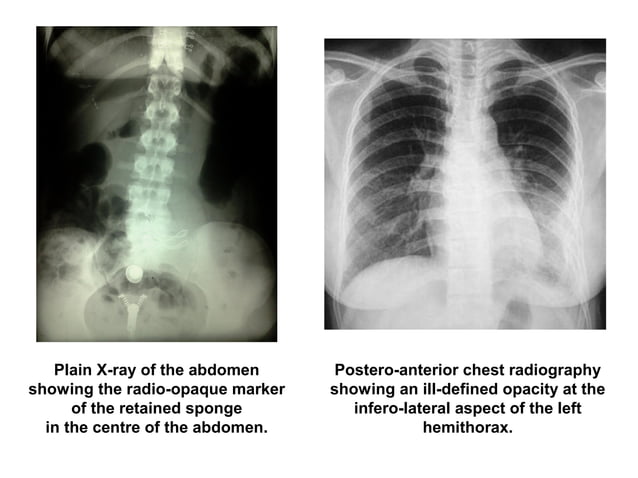 Postoperative retained foreign bodies | PDF | Digestive Disorders ...