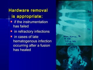HH a arrddwwaarree rreemmoovvaall 
iiss aapppprroopprriiaattee:: 
iiff tthhee iinnssttrruummeennttaattiioonn 
hhaass ffaaiilleedd 
iinn rreeffrraaccttoorryy iinnffeeccttiioonnss 
iinn ccaasseess ooff llaattee 
hheemmaattooggeennoouuss iinnffeeccttiioonn 
ooccccuurrrriinngg aafftteerr aa ffuussiioonn 
hhaass hheeaalleedd 
 