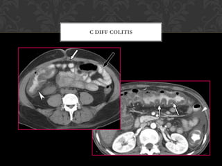 Postoperative Surgical Complications.ppt