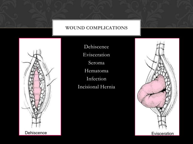 postoperative-surgical-complications-ppt