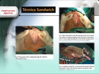 Complicaciones
digestivas
 