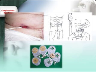 Complicaciones
digestivas
 