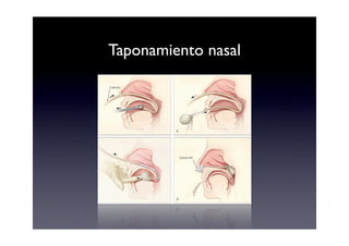Taponamiento nasal
 