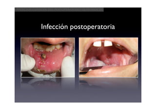 Aspectos clínicos del postoperatorio quirúrgico




             Infección postoperatoria
 