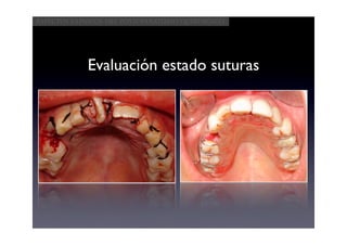Aspectos clínicos del postoperatorio quirúrgico




            Evaluación estado suturas
 