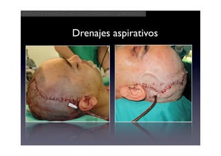Aspectos clínicos del postoperatorio quirúrgico




                   Drenajes aspirativos
 