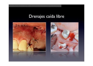 Aspectos clínicos del postoperatorio quirúrgico




                 Drenajes caída libre
 