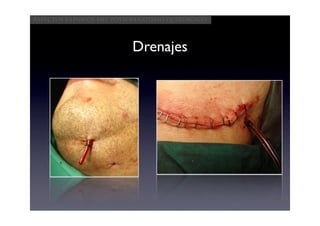 Aspectos clínicos del postoperatorio quirúrgico



                          Drenajes
 