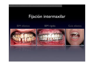 Aspectos clínicos del postoperatorio quirúrgico




                 Fijación intermaxilar
      BIM elástico             BIM rígido         Guía elástica
 