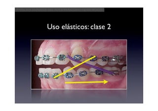 Aspectos clínicos del postoperatorio quirúrgico




                Uso elásticos: clase 2
 